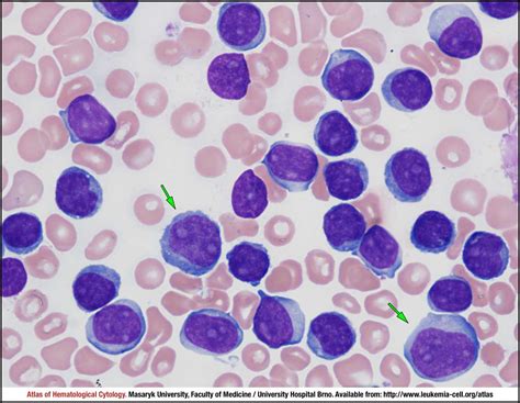 T Cell Prolymphocytic Leukaemia Cell Atlas Of Haematological Cytology