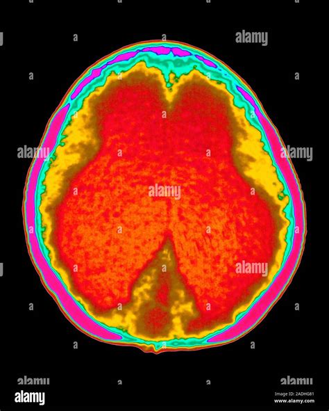 Hydrocephalus Coloured Computed Tomography Ct Scan Of An Axial