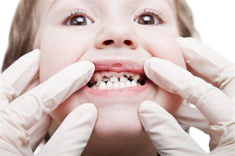 Early Stages Of Tooth Decay Spotting Tooth Decay Symptoms