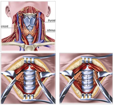 Tracheostomy Procedure Anatomy