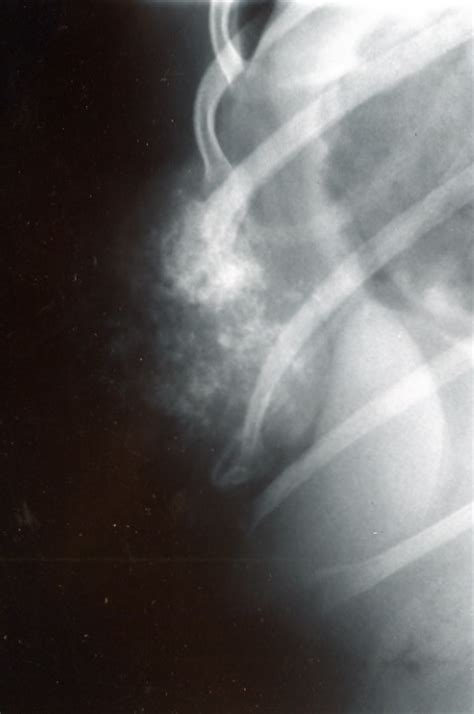 Bone Tumors Rib — Dr Julius Liptak