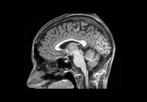 Mri Image Of A Healthy Brain Mri Brain Brain Mri Radiologic Technology