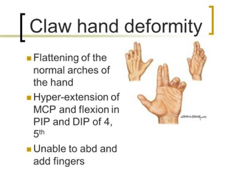 Ulnar Nerve Claw Hand