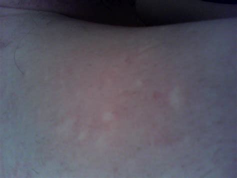 I Have Firm White Bumps Not Acne On My Shoulders It Looks