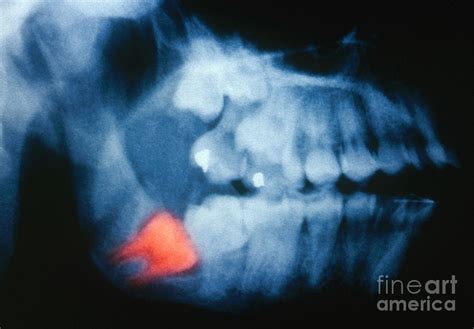 Impacted Wisdom Tooth X Ray Photograph By Scott Camazine