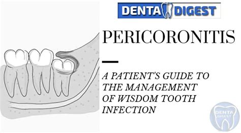 Wisdom Tooth Infection A Patients Guide To Manage Pericoronitis