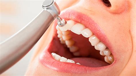 La Importancia De La Limpieza Dental Clínica Dental Elena Fatás