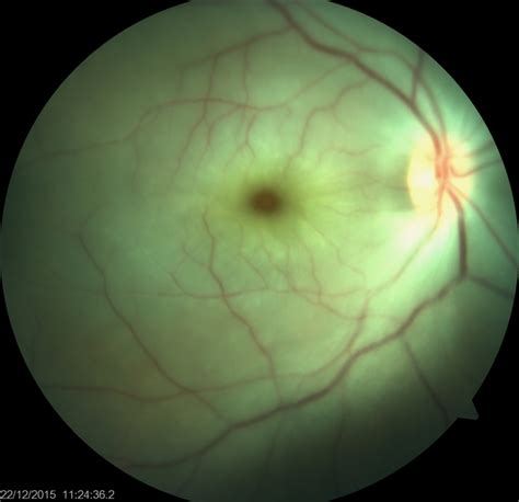 Figure Central Retinal Arterial Occlusion Right Eye Contributed By