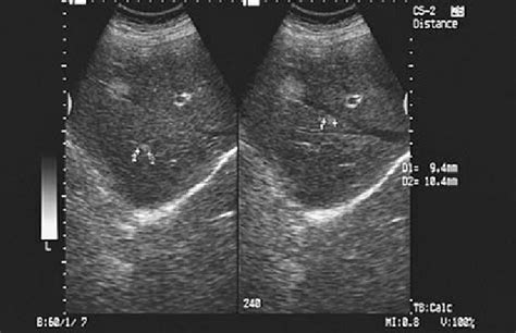 Multiple Focal Nodular Hyperplasia Ultrasonographic Aspect