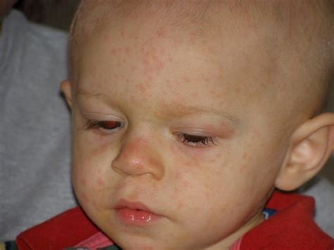 Аллергическая сыпь у детей фото на теле с пояснениями и описанием