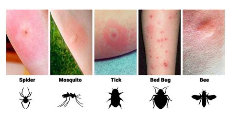 Identifying Bug Bites On Humans