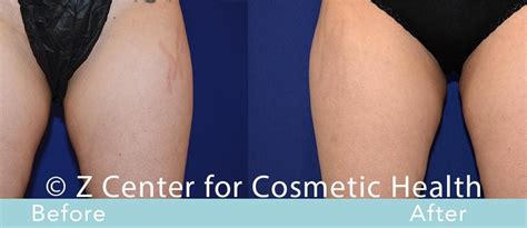 coolsculpting inner thighs before and after 3 zcosmetic health