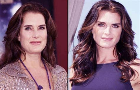 Brooke Shields Before And After Plastic Surgery 45 Celebrity Plastic