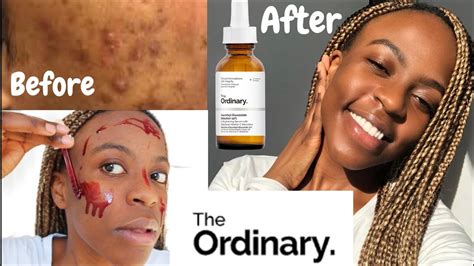 Skin How To Get Rid Of Acne And Hyperpigmentation Using The Ordinary