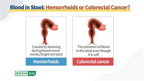 Know The Difference Between Hemorrhoids And Colorectal Cancer And When