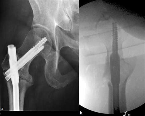 Intertrochanteric Hip Fractures Radiology Key