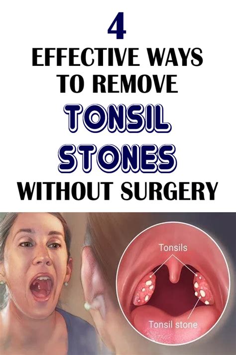 4 Effective Ways To Remove Tonsil Stones Without Surgery