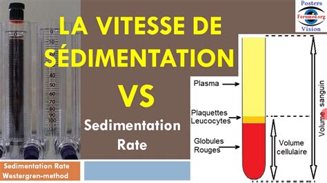 Published on oct 30, 2014. Methode Mesure de la vitesse de sedimentation rate VS ESR ...