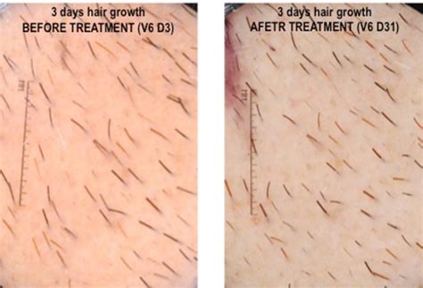 There is no way to stop the growth of body hair, unless laser hair removal is used repeatedly for dark hairs. Mens grooming and other body hair