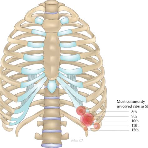 Macroscopic Anatomy Of The Costal Cartilage In Slipping Rib Syndrome