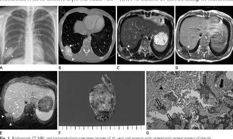 Figure 1 From Primary Osteoblastic Osteosarcoma Of The Rib In An Adult