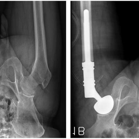 A 68 Year Old Man Had A Right Hip Pain Without Trauma A