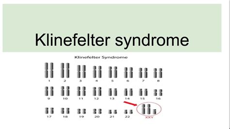 Klinefelter Syndrome Drawing