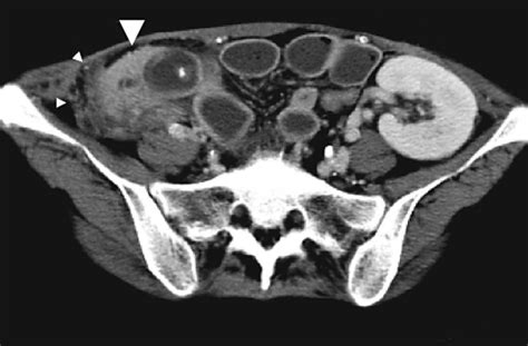 Abdominal Computed Tomography Ct Revealed A Swollen Pancreas Graft By
