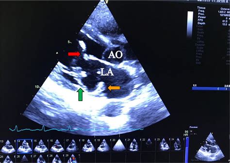 Echocardiogram Parasternal Long Axis View Showing Vegetations In The