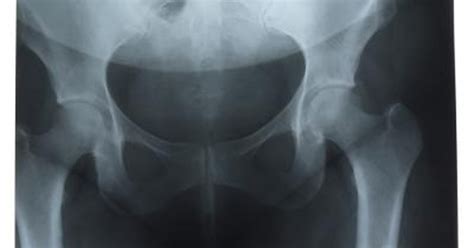 Causes Of Hip And Pelvic Pain Livestrongcom