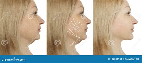 Woman Double Chin Before And After Treatment Stock Image Image Of