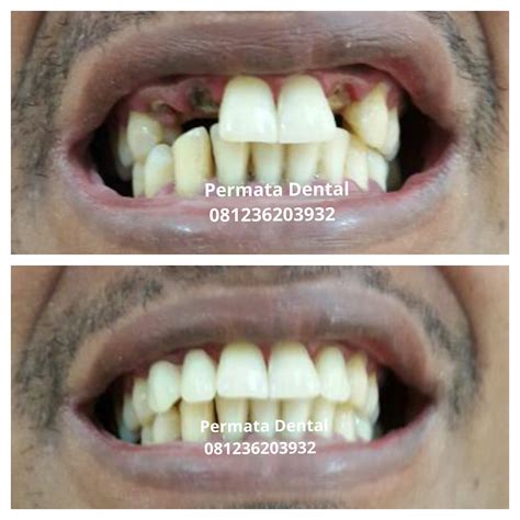 Kemudian dibagi lagi berdasarkan jenis bahan yang digunakan. Ahli Gigi Bali | Permata Dental: Pasang Gigi Palsu Lepas ...
