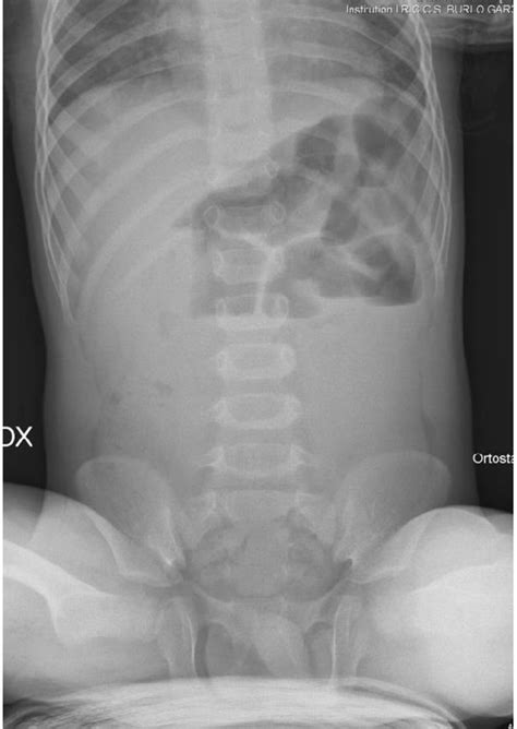 Tea and yogurt may also help, but they’re not always included with the diet. Acute small bowel obstruction in a child with a strict raw