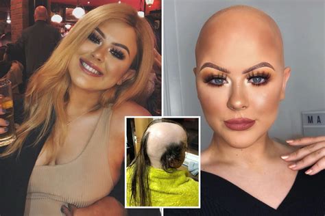 Make Up Artist Who Was Diagnosed With Alopecia At 16 And Tried To Cover Her Bald Spots With Dry