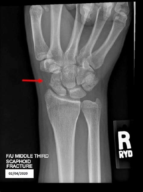 Cureus Conservatively Managed Displaced Scaphoid Fracture In A Young