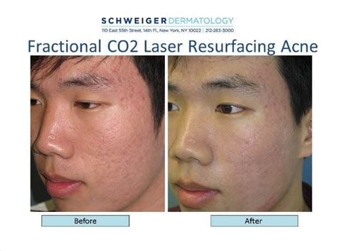 Fractional Co2 Laser Resurfacing Acne Yelp