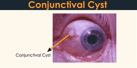 Conjunctival Cyst 24 Hours Of Biology