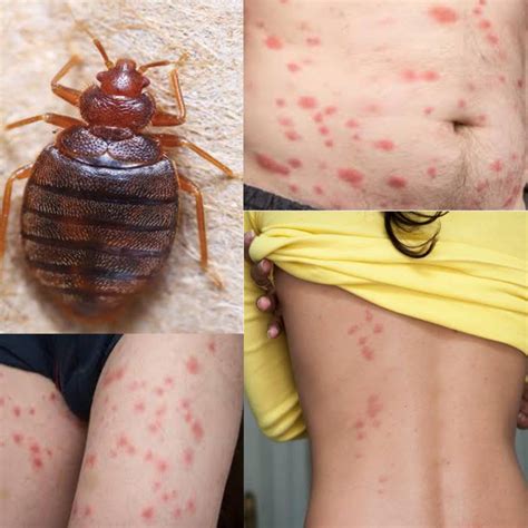 What Do Bed Bug Bites Look Like Pictured Public Health