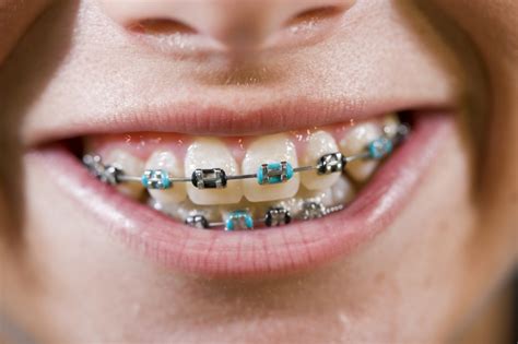 Coloured Braces In Surrey Guildford Orthodontic Centre