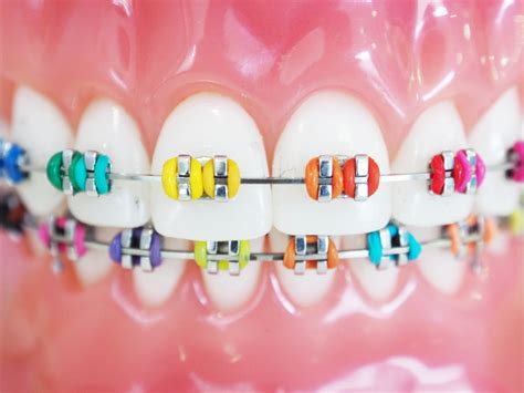 What Braces Color Are Used For Orthodontic Services