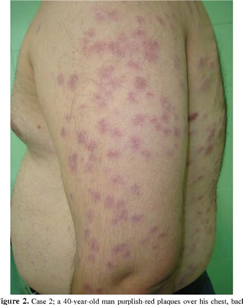 PDF Cutaneous Leishmaniasis With Unusual Clinical And Histological Presentation Report Of