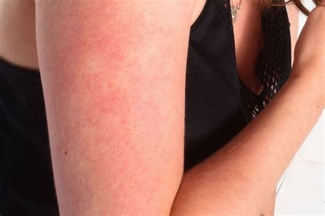 The Red Bumps At The Tops Of Arms Are Actually A Common Skin Condition