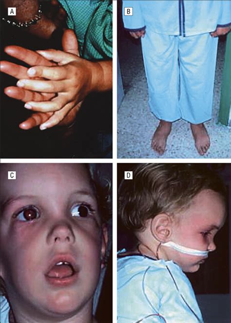 Atypical Retinoblastoma In Sotos Syndrome Cerebral Gigantism