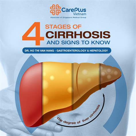 Stages Of Cirrhosis And Sign To Know