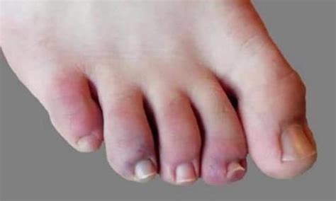 Além das questões respiratórias, frieiras e manchas na pele podem indicar infecção pelo. Conheça manifestações na pele notadas em pacientes com ...