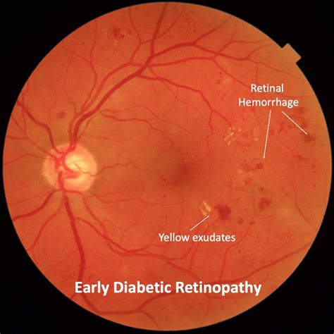 Diabetic Retinopathy Mr Ellabban Eye Surgery Yorkshire And Hull