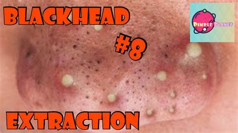 Blackhead Extraction Session 8 2019 Most Satisfying Pimple Popping 擠痘痘
