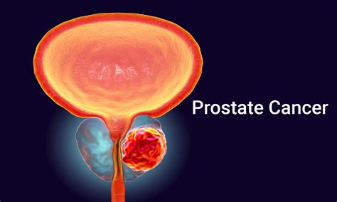 Prostate A