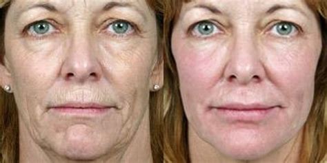 Thermagie Cpt Fractional Rf Treatment Sydney 1 Tighter Skin