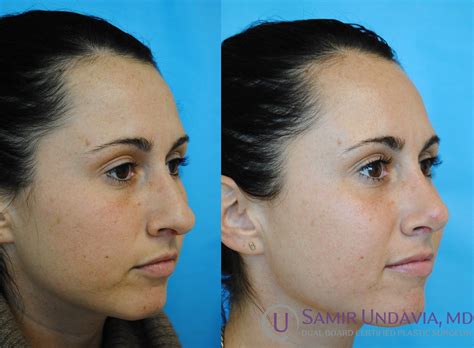 Rhinoplasty Rhinoplasty Nose Surgery Nose